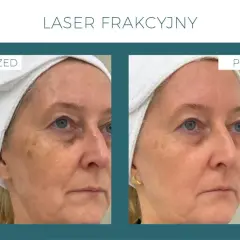 Laser frakcyjny nieablacyjny: odmłodź skórę bez długiej rekonwalescencji.