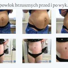 Liposukcja: Co to jest i czy to rozwiązanie dla Ciebie?