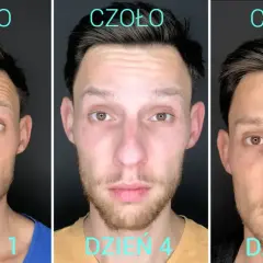 Botoks na czoło: Ile trwa efekt i co zrobić, by był dłuższy?