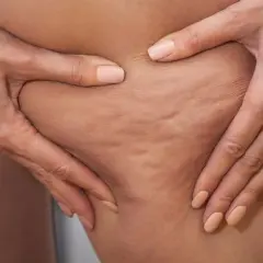 Jak pozbyłam się cellulitu? Mój osobisty plan na gładką skórę