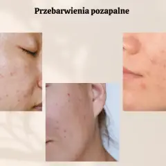 Czerwone plamy po pryszczach: Jak skutecznie pozbyć się PIE?
