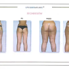 Endermologia: Ile zabiegów dla gładkiej skóry? Plan kuracji