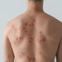 Plecy mężczyzny z licznymi czerwonymi, zapalnymi zmianami skórnymi i przebarwieniami.