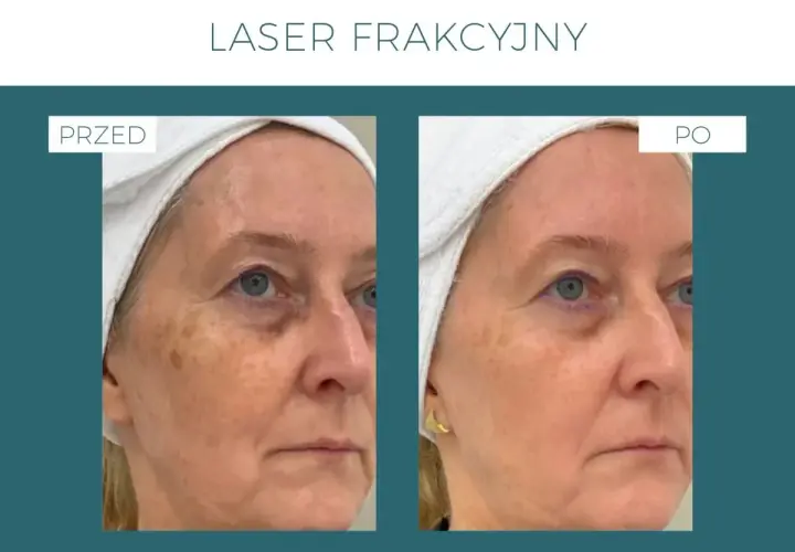 Laser frakcyjny nieablacyjny: odmłodź skórę bez długiej rekonwalescencji.