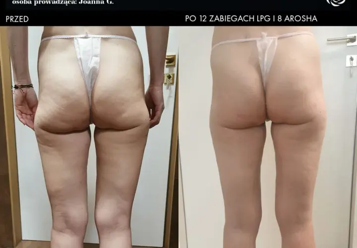 Endermologia: Ile cm stracisz w obwodzie? Mierzalne efekty!