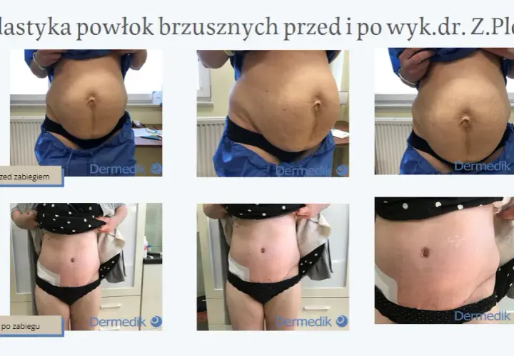 Liposukcja: Co to jest i czy to rozwiązanie dla Ciebie?