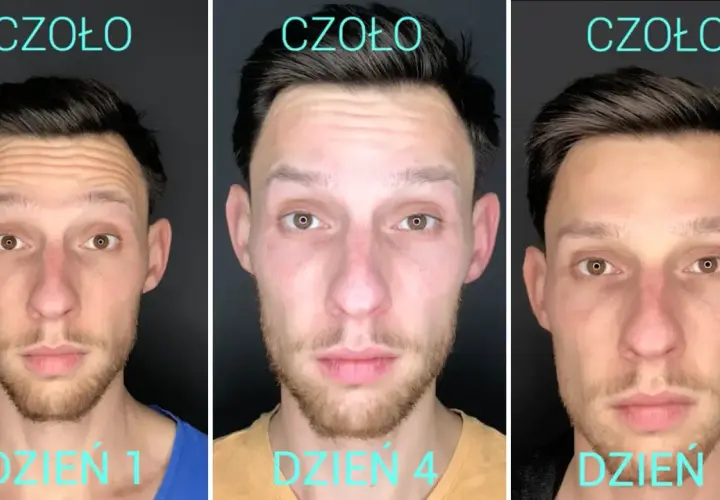 Botoks na czoło: Ile trwa efekt i co zrobić, by był dłuższy?