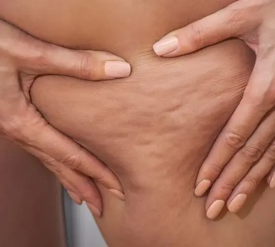 Jak pozbyłam się cellulitu? Mój osobisty plan na gładką skórę