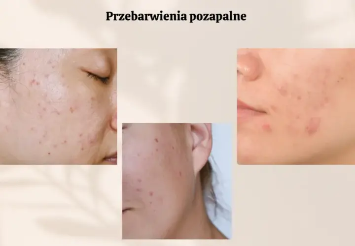 Czerwone plamy po pryszczach: Jak skutecznie pozbyć się PIE?