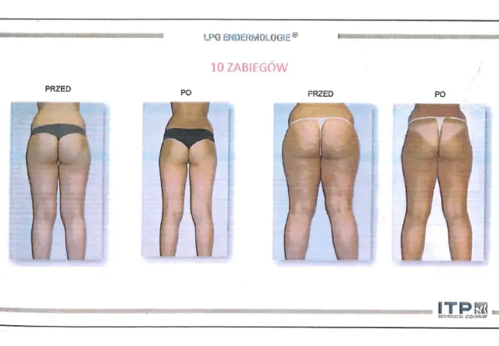 Endermologia: Ile zabiegów dla gładkiej skóry? Plan kuracji