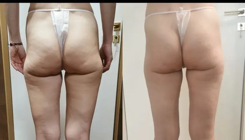 Endermologia: Ile cm stracisz w obwodzie? Mierzalne efekty!