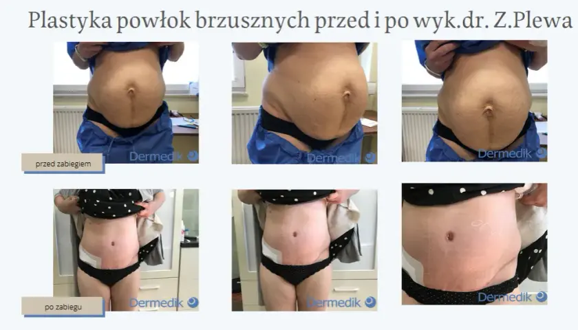 Liposukcja: Co to jest i czy to rozwiązanie dla Ciebie?