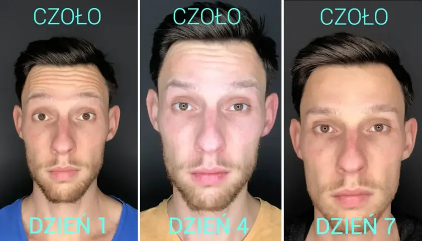 Botoks na czoło: Ile trwa efekt i co zrobić, by był dłuższy?