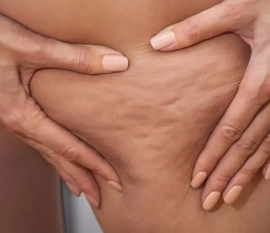 Jak pozbyłam się cellulitu? Mój osobisty plan na gładką skórę