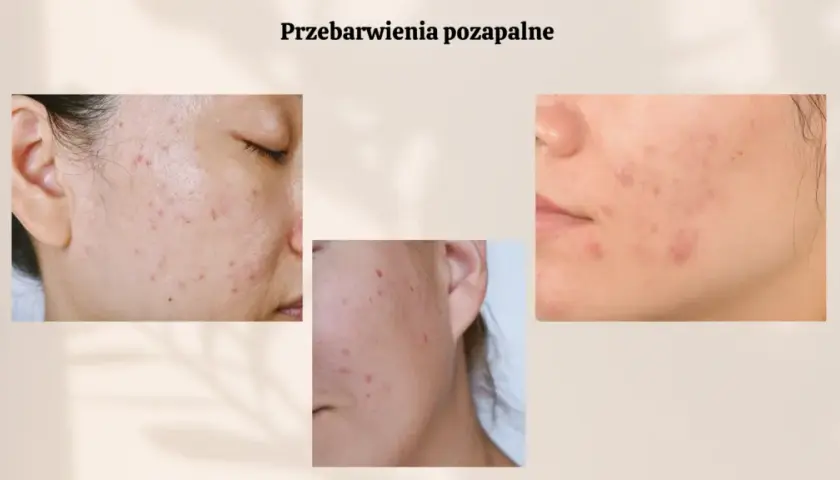 Czerwone plamy po pryszczach: Jak skutecznie pozbyć się PIE?
