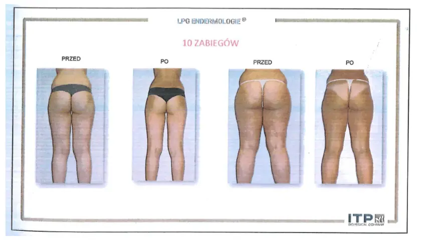 Endermologia: Ile zabiegów dla gładkiej skóry? Plan kuracji