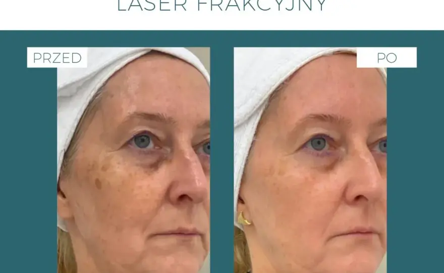 Laser frakcyjny nieablacyjny: odmłodź skórę bez długiej rekonwalescencji.