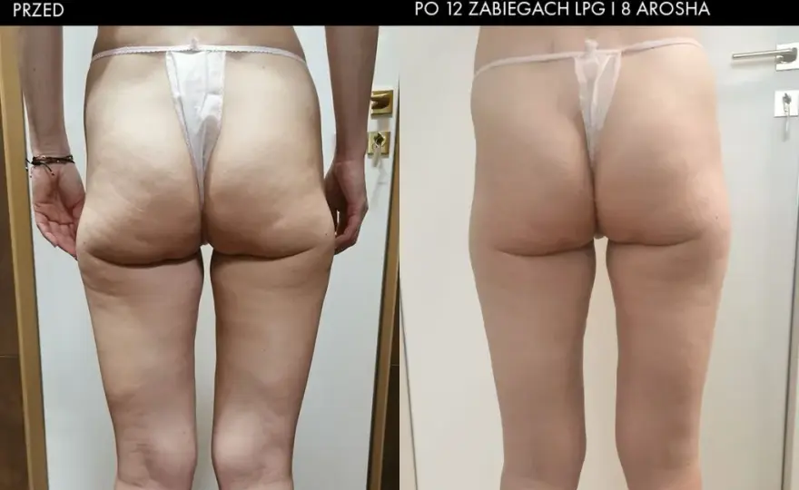 Endermologia: Ile cm stracisz w obwodzie? Mierzalne efekty!