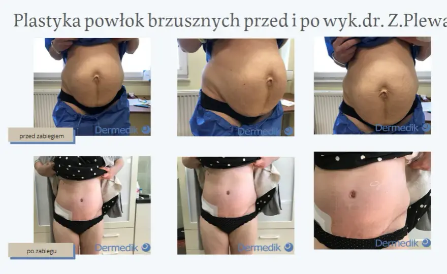 Liposukcja: Co to jest i czy to rozwiązanie dla Ciebie?
