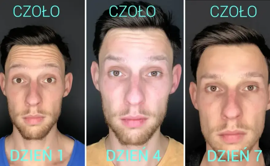 Botoks na czoło: Ile trwa efekt i co zrobić, by był dłuższy?