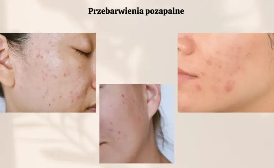 Czerwone plamy po pryszczach: Jak skutecznie pozbyć się PIE?
