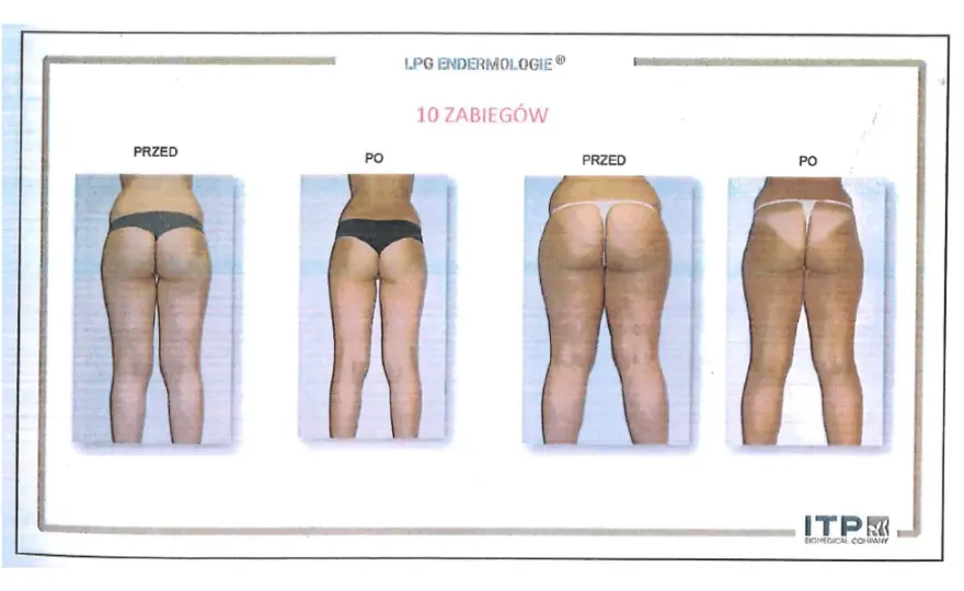 Endermologia: Ile zabiegów dla gładkiej skóry? Plan kuracji