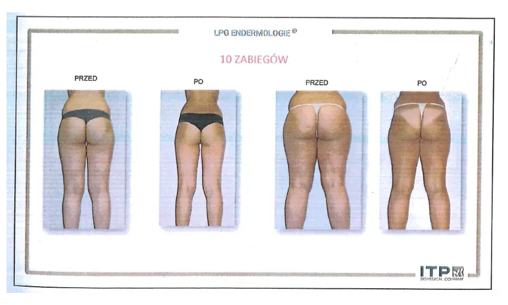 Endermologia: Ile zabiegów dla gładkiej skóry? Plan kuracji