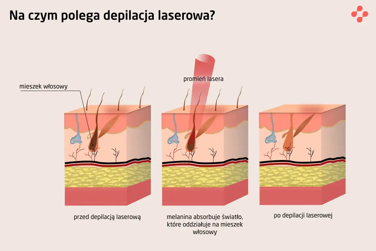 depilacja laserowa twarzy jak działa schemat
