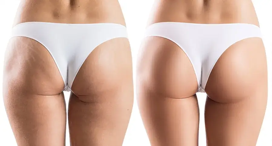 różne metody liposukcji porównanie