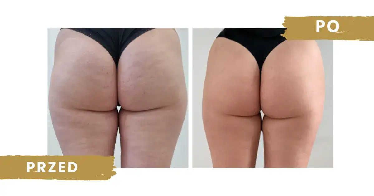 endermologia na cellulit przed i po
