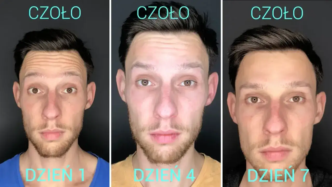 botoks czoło przed po efekty