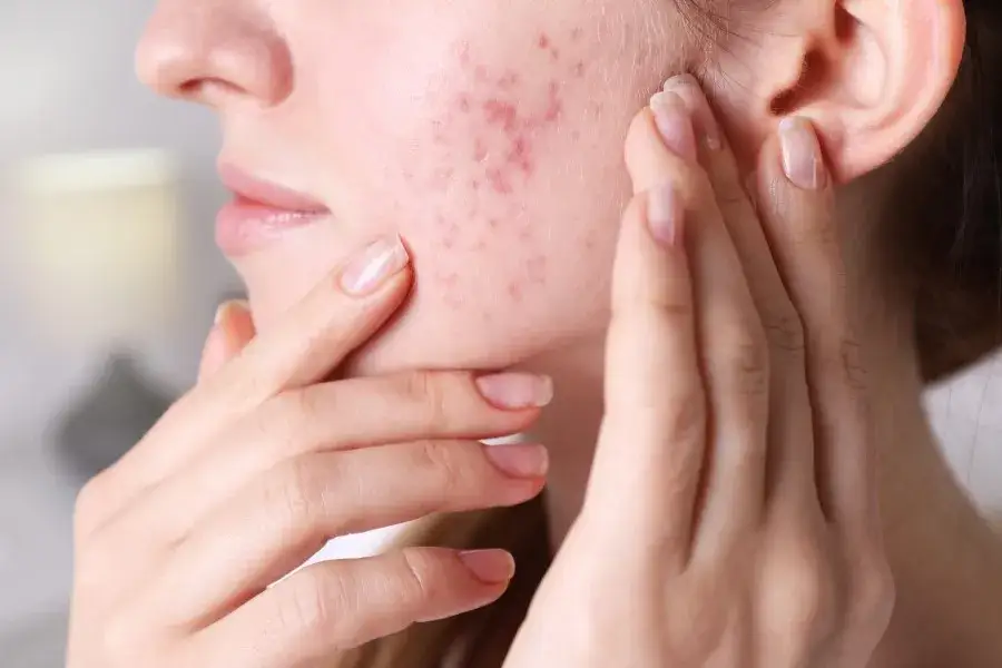 kiedy iść do dermatologa pryszcze