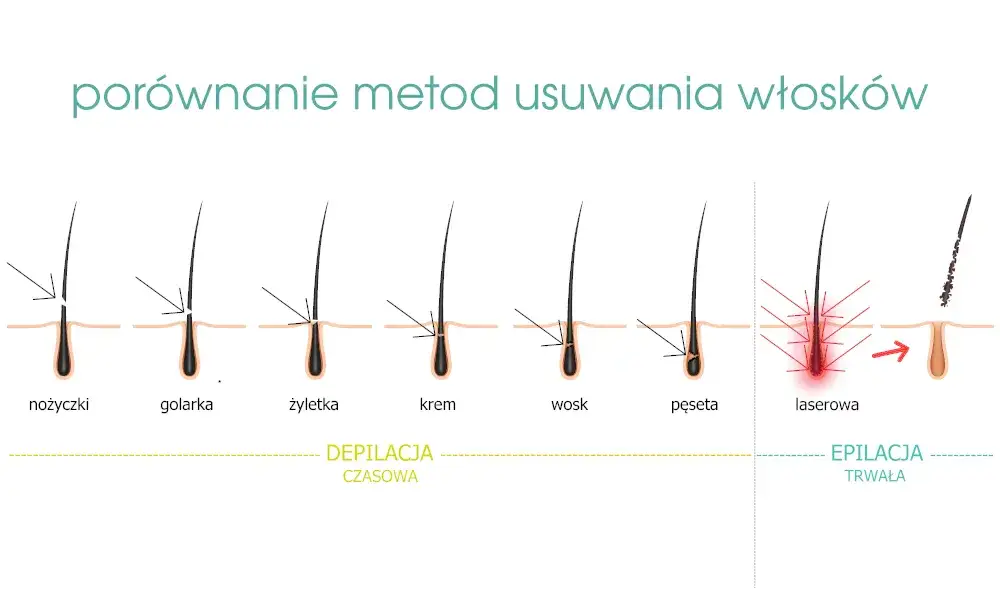 Porównanie bólu depilacji laserowej, woskiem i depilatorem