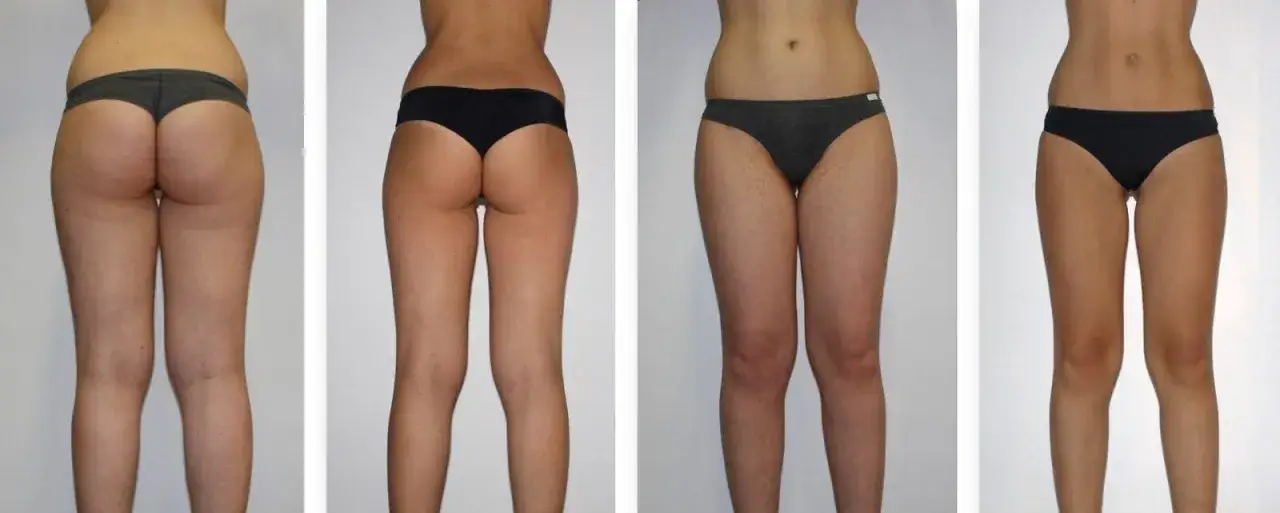 endermologia Alliance przed i po
