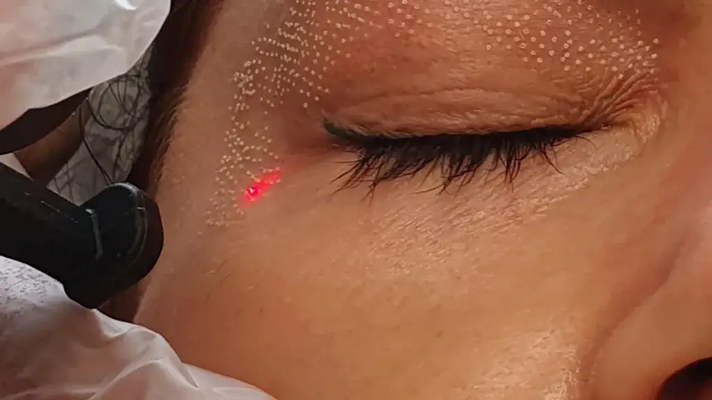 Makijaż mineralny po laserze frakcyjnym