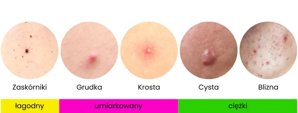 różne rodzaje pryszczy trądzikowych