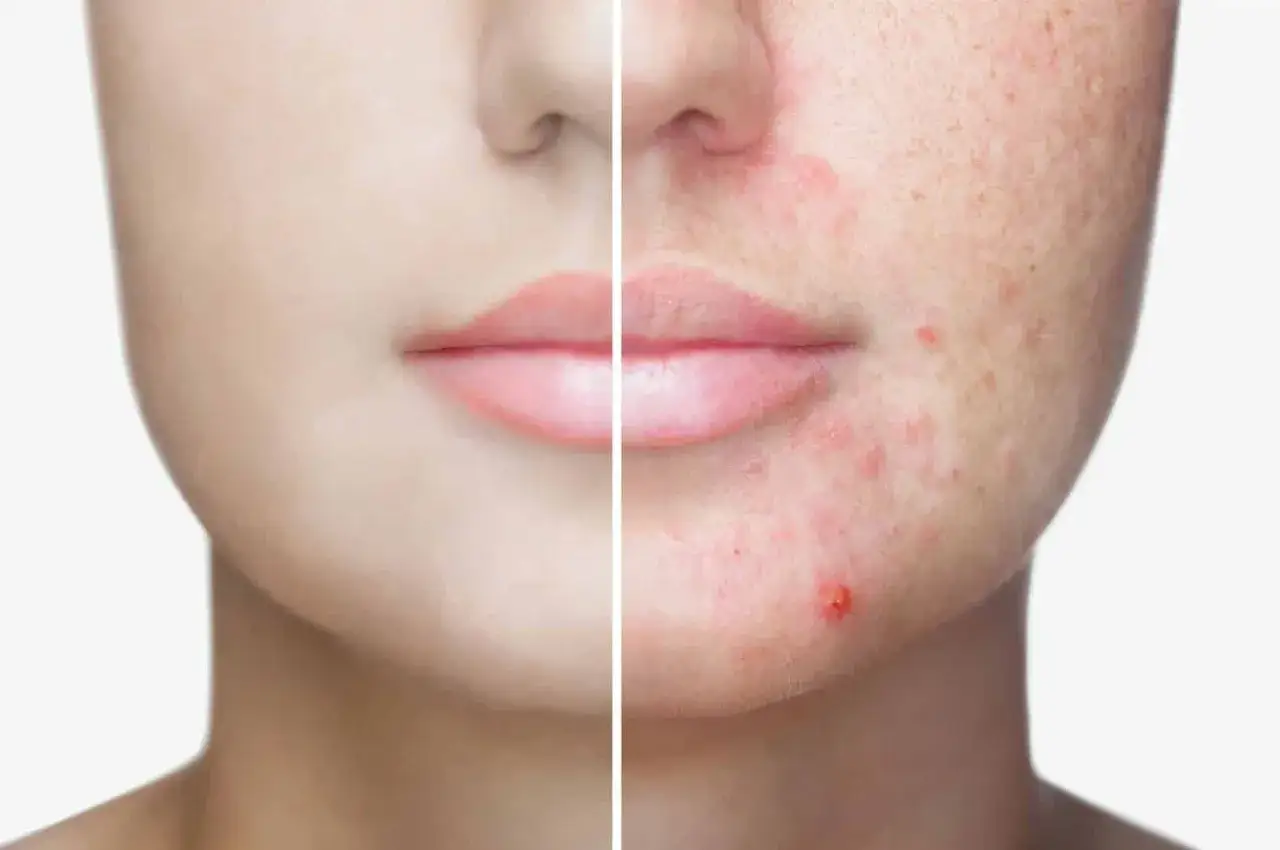 zabiegi dermatologiczne na trądzik